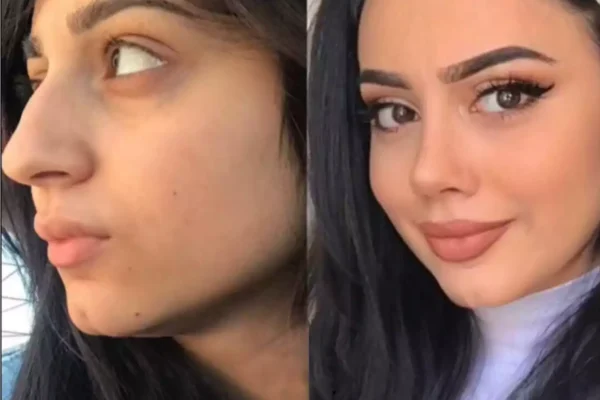 rhinoplasty in dubai