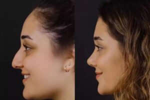Septoplasty in Dubai