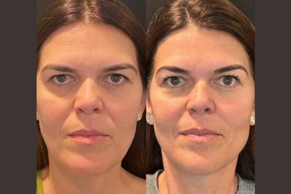 Thread lift in Dubai