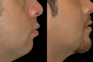 Double chin removal in Dubai