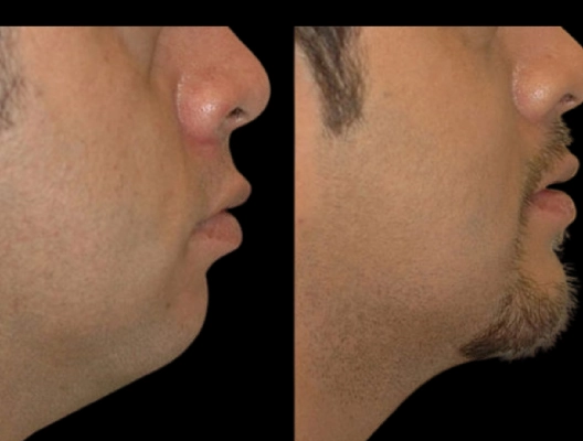 Double chin removal in Dubai
