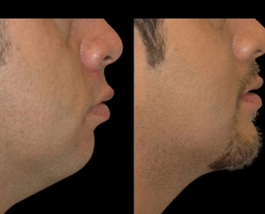Double chin removal in Dubai
