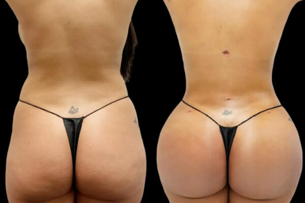 Butt Fat Transfer in dubai