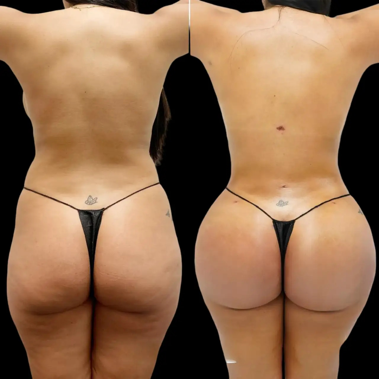 Butt Fat Transfer in dubai