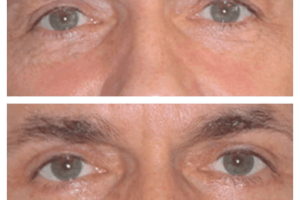 Eye Bag Removal in Dubai
