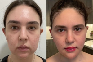 Buccal Fat Removal in Dubai