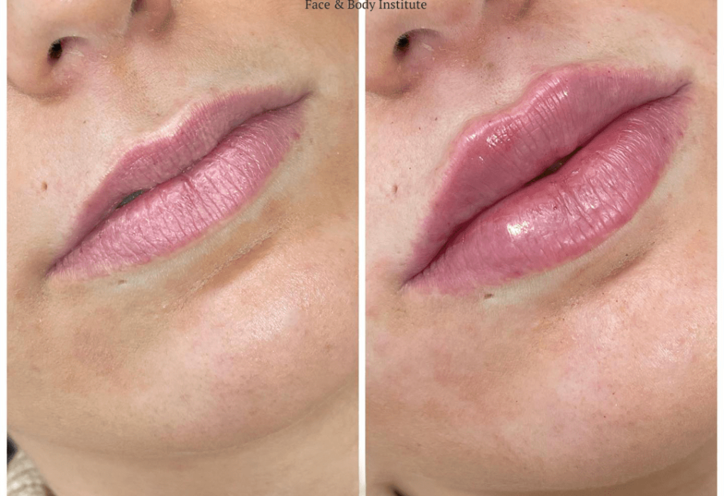 Juvederm in Dubai