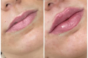 Juvederm in Dubai