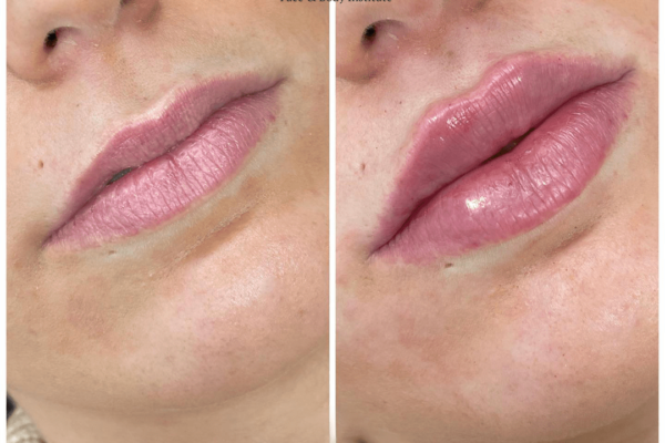 Juvederm in Dubai