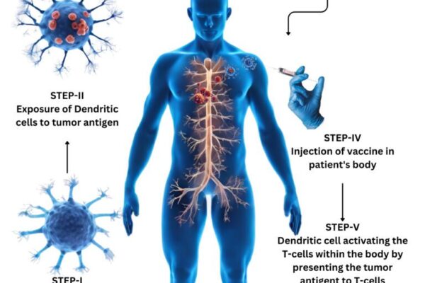 dendritic cell therapy