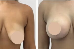 Breast Reduction in Dubai