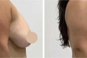 breast lift in Dubai
