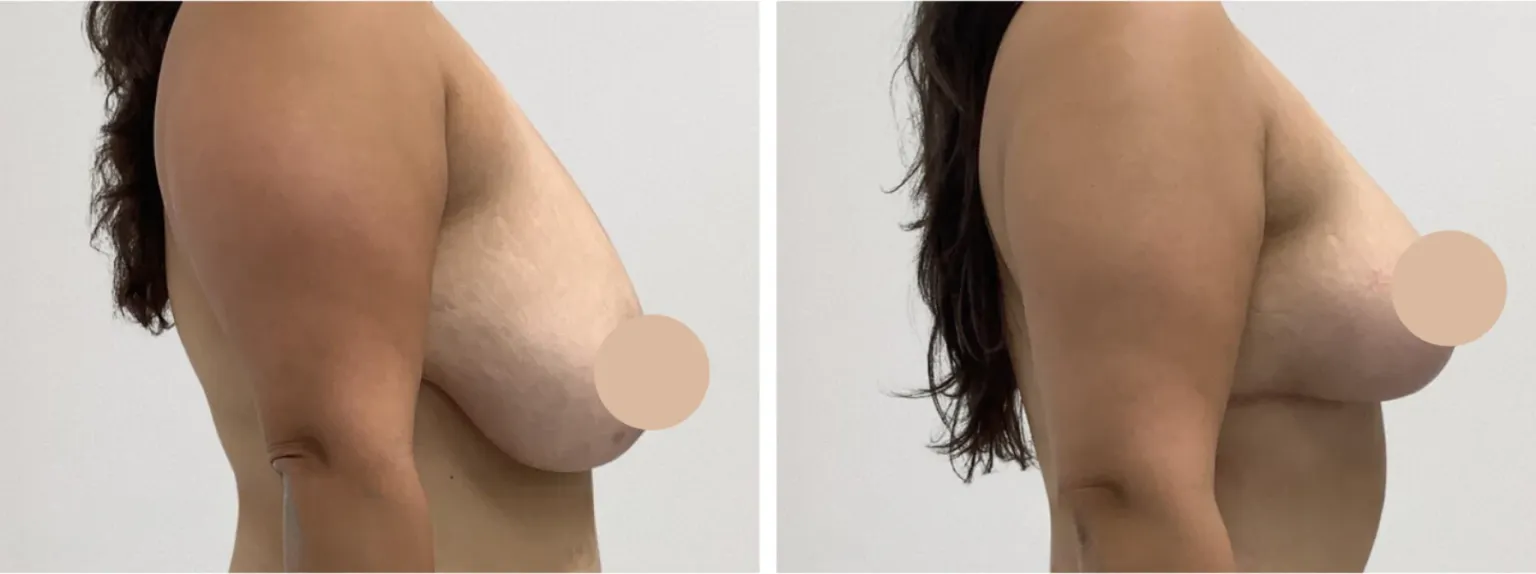breast lift in Dubai