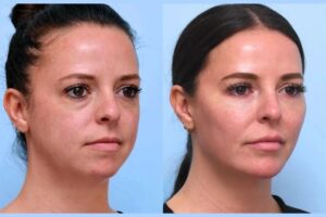 Best Aesthetic Clinic in Dubai Specializing in Thread Lift Treatments