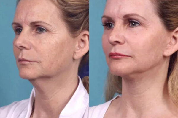 Chemical Peel in Dubai