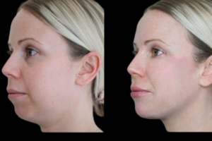 Jawline Fillers in Dubai