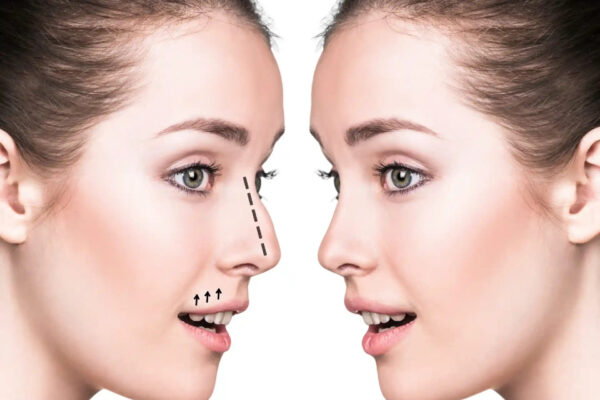 Rhinoplasty in Dubai