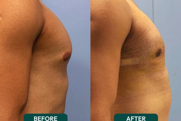 gynecomastia surgery before and after
