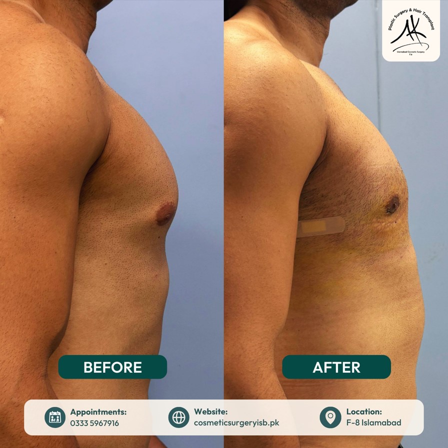 gynecomastia surgery before and after