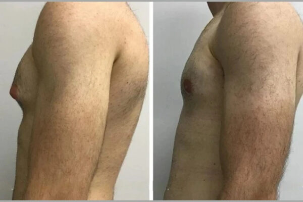 gynecomastia in Dubai