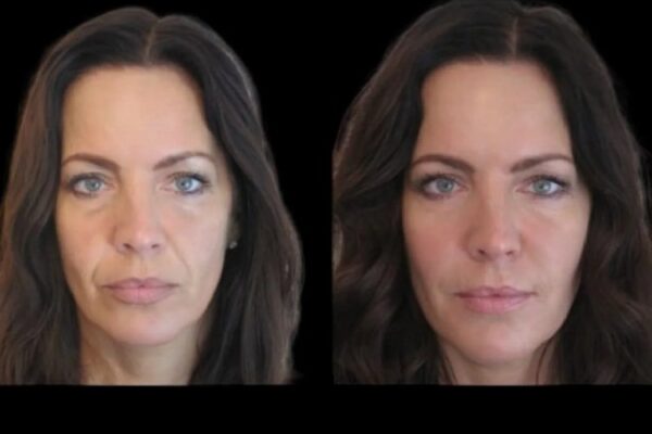 jawline fillers in Dubai