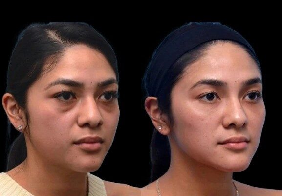 Dark Circles Treatment in Dubai