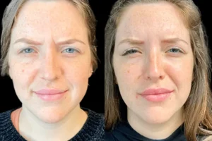 Best Aesthetic Clinic in Dubai for Forehead Botox and Frown Lines