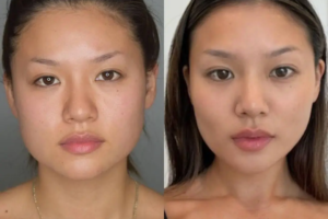 Buccal Fat Removal in Dubai