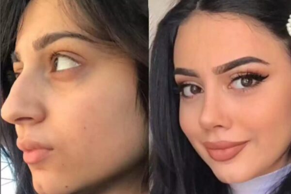 Rhinoplasty in Dubai