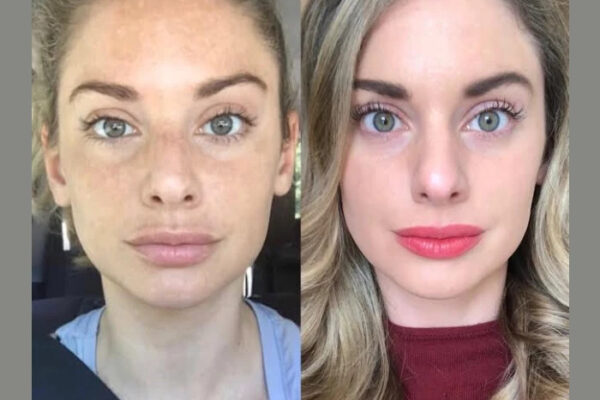 RF-Microneedling in dubai