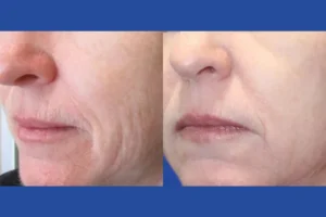 fractional-rf-microneedling in dubai