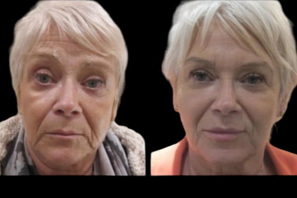 Jawline Fillers in Dubai