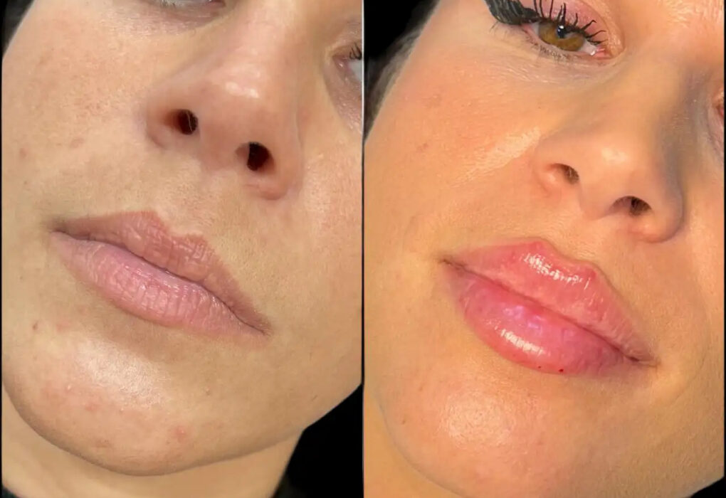 Dermal Fillers in Dubai