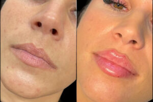 Dermal Fillers in Dubai