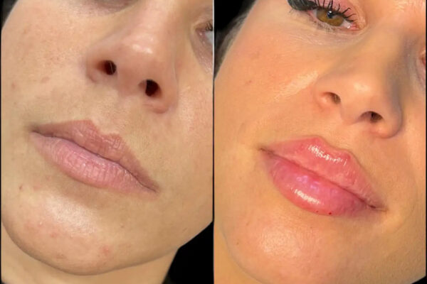 Dermal Fillers in Dubai
