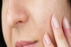 How Large Pores Treatment in Riyadh Helps Improve Skin Texture