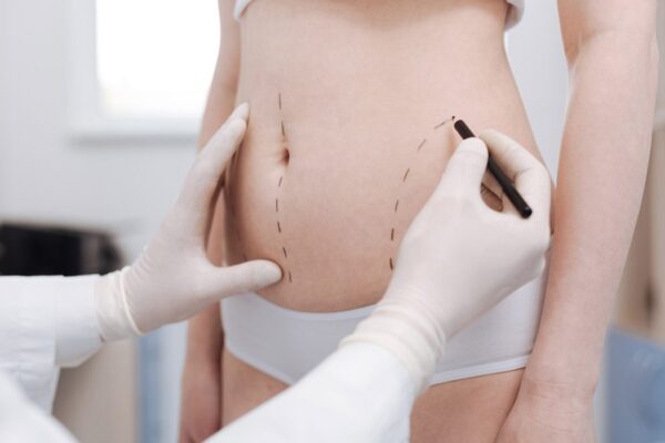 liposuction in dubai