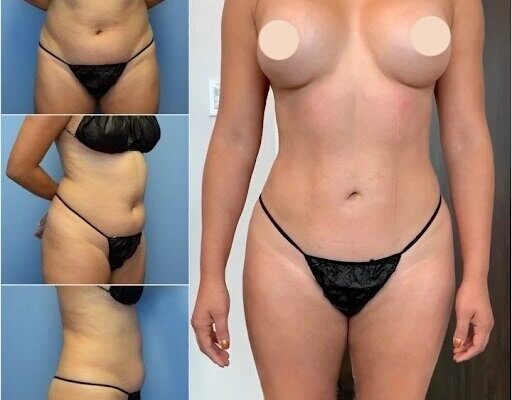 Body Contouring in Dubai
