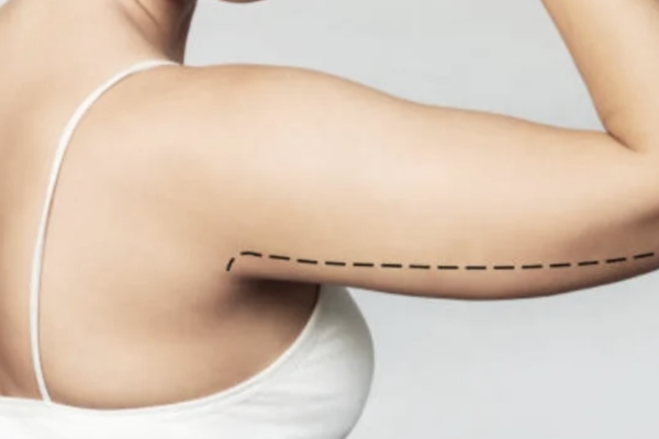 Best Arm Liposuction In Dubai