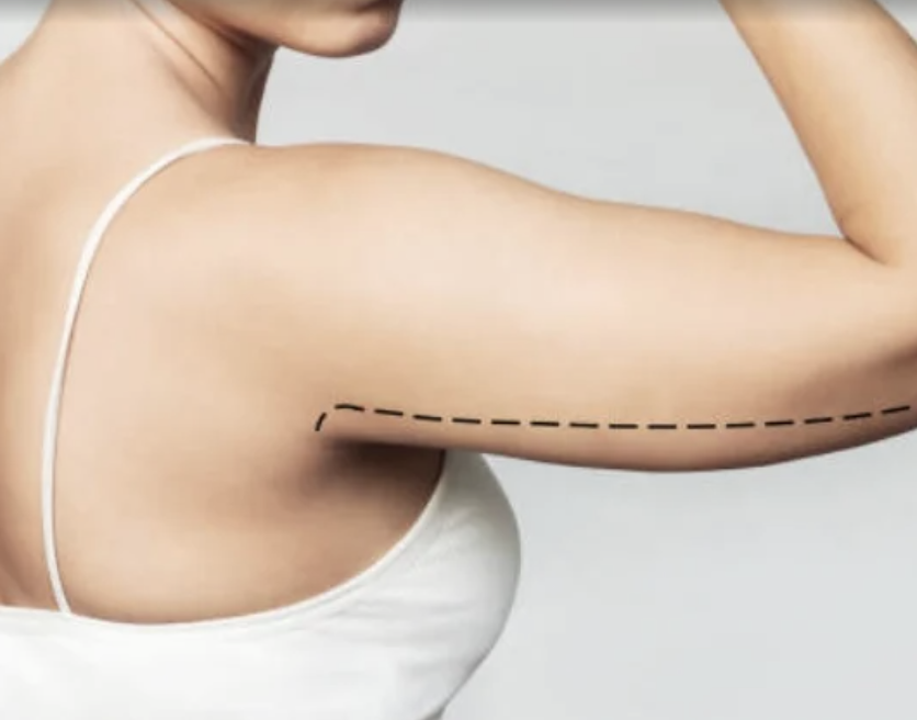 Best Arm Liposuction In Dubai