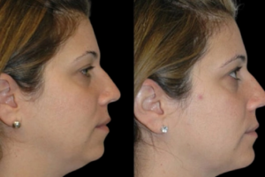 Double chin removal in Dubai