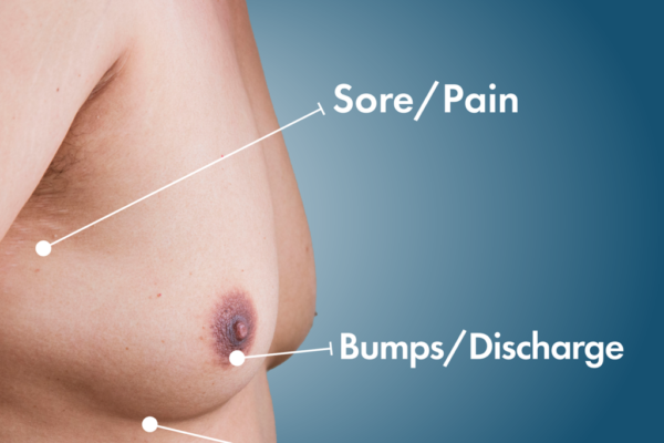 gynecomastia in islamabad