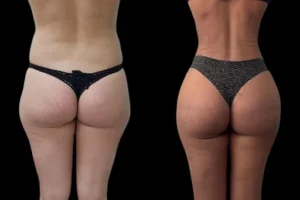 J-Plasma Treatment in Dubai