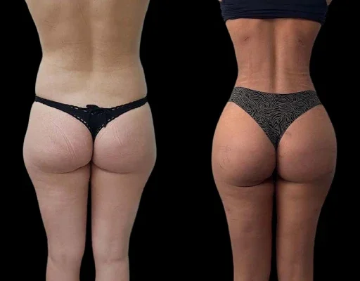 J-Plasma Treatment in Dubai