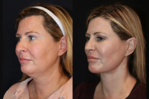 Skin Tightening Treatment in Dubai
