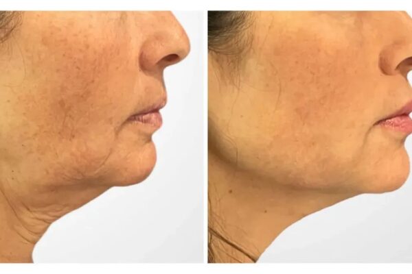 Thread Lift Treatment in Dubai Offering Innovative Techniques