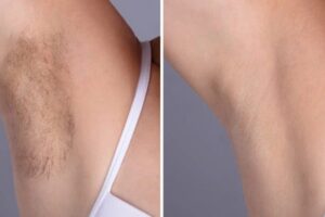 Laser hair removal in Dubai
