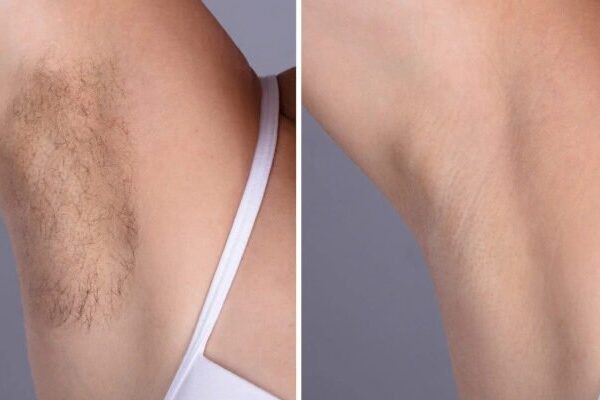Laser hair removal in Dubai