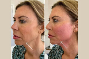 Endolift Treatments in Dubai for Enhancing Facial Symmetry