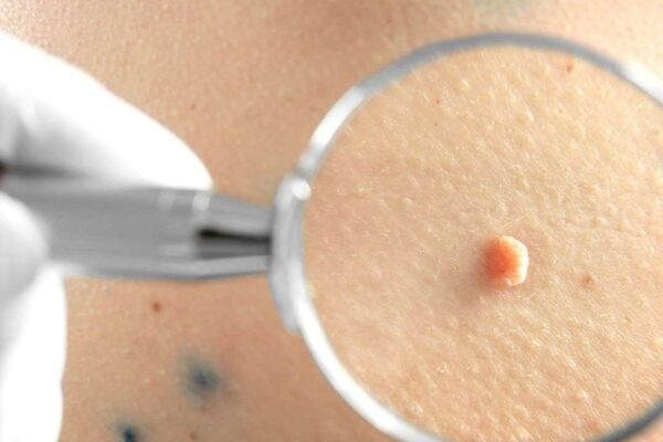 Moles Removal in Dubai